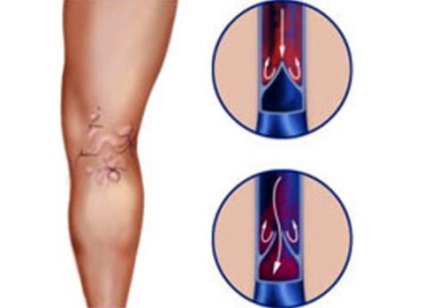 Какво се случва, варици основни форми и видове разширени вени