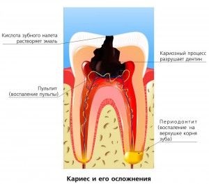 Як запобігти карієс зубів