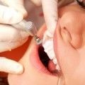 Cum să preveniți cariile dentare