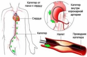 Chistul simptomelor pericardice, tipurile, metodele de tratament și complicațiile