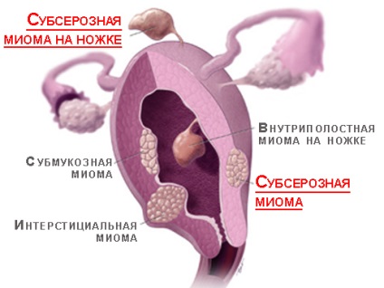 Clasificarea miomului uterin