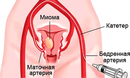 Clasificarea miomului uterin