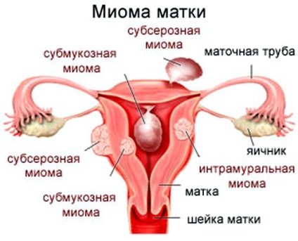 Clasificarea miomului uterin