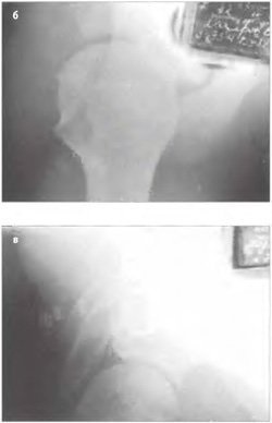 Examinarea radiologică clinică a articulației umărului