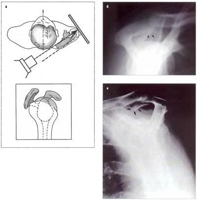 Examinarea radiologică clinică a articulației umărului