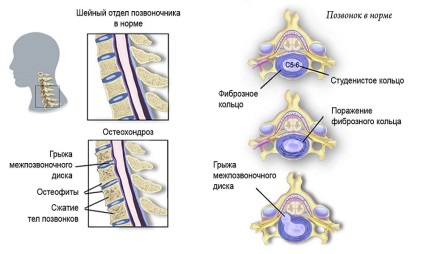 Fizioterapie și lfk cu instabilitate a coloanei vertebrale cervicale