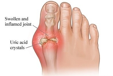 Tratamentul artritei piciorului la domiciliu