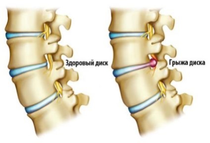 Tratamentul herniei medicamentelor din coloana vertebrală și remedii folclorice