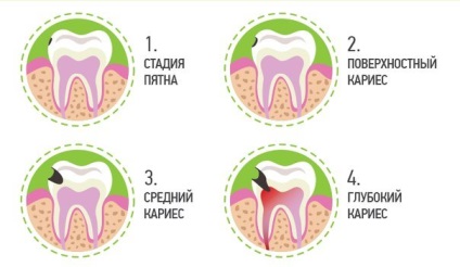 Tratamentul cariilor fără durere în Odintsovo și Golitsyno în jurul ceasului