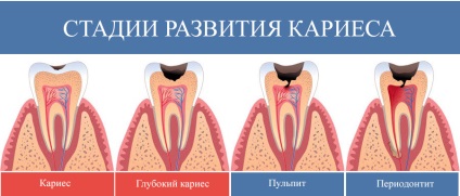Tratamentul pretului cariilor, simptomelor, stadiilor de dezvoltare