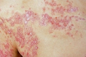 Tratamentul psoriazisului cu peroxid de hidrogen, tratamentul psoriazisului