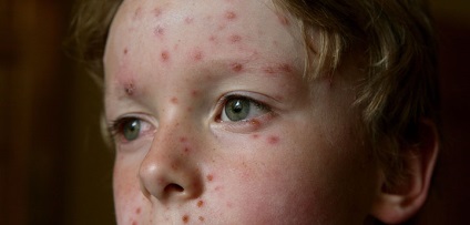 Medicamentul pentru varicela la copii este viferon, kagocel, antiviral, antibiotice