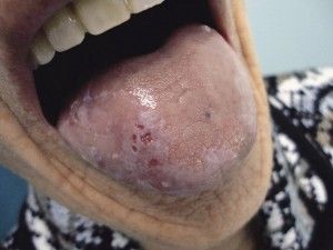 Leucoplazie a tratamentului cavității bucale și a limbii la domiciliu