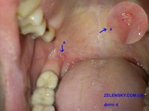 Leucoplazie a tratamentului cavității bucale și a limbii la domiciliu