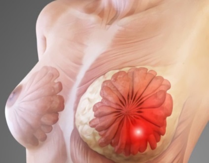 Mastopatia sânului - care sunt simptomele și semnele, tratamentul