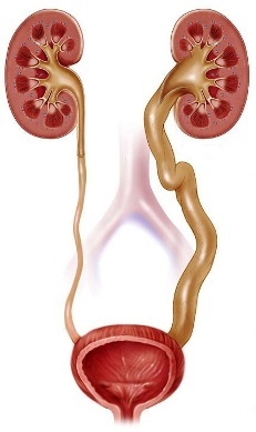 Megaureter - displazie neuromusculară a ureterului