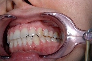 Lehetőség van arra, hogy fogászati ​​implantátumok jelenlétében mrt-t csináljanak vagy készítsenek fogászati ​​implantátumokkal, stomat-hatás