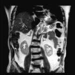 гръбначния стълб MRI