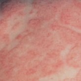 Tratamentul popular al eczemelor