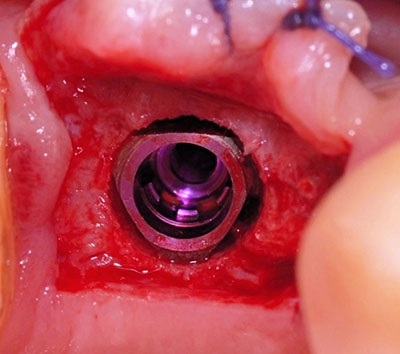 Noul implant v3 din implanturi greșite