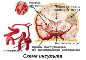 Un accident vascular cerebral extins ce este și care este probabilitatea de comă în această stare