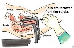 Oncocitologia uterului de col uterin - rezultate, metode