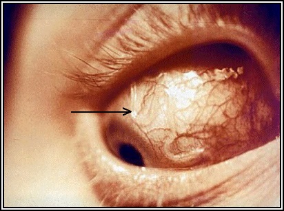 Onchocerciasis és loiasis hordozók emberekben, tünetek, képek, diagnózis, kezelés, megelőzés