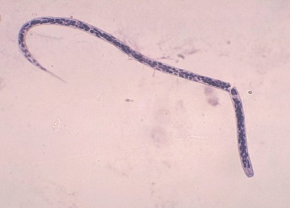 Onchocerciasis și loiasis la transportatorii umani, simptome, fotografii, diagnostic, tratament, prevenire