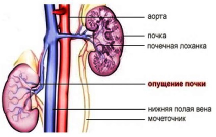Tratamentul deficitului de rinichi și consecințele acestuia