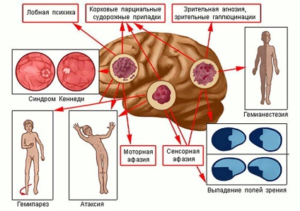 agydaganat kezelésére, diagnosztizálására, sebészeti beavatkozás