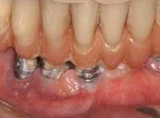 Complicații după implantarea dinților
