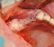 Complicații după implantarea dinților