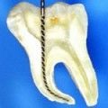 Efectul de prelucrare a smalțului dintelui și repararea clivajului