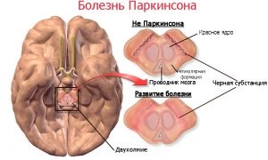 Boala Parkinson, cauze și tratament, anatomia sănătății