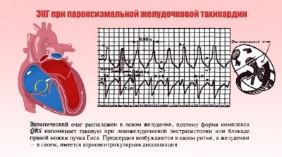 Cauzele tahicardiei paroxistice, simptomele și tratamentul acesteia