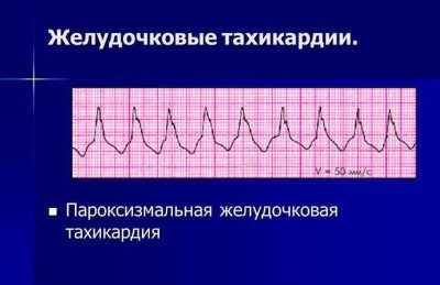 Cauzele tahicardiei paroxistice, simptomele și tratamentul acesteia