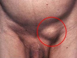 Hernia inghinala la femei, simptome, tratament, diagnostic (foto)