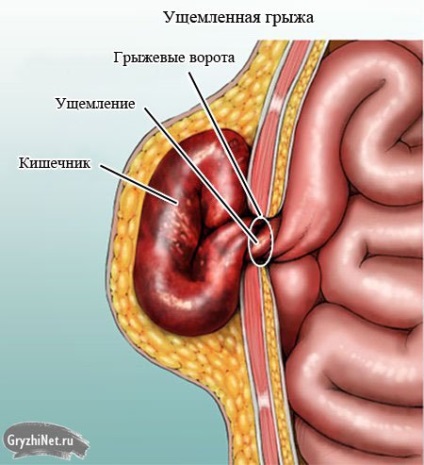 Hernia inghinala la femei, simptome, tratament, diagnostic (foto)