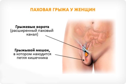 Hernia inghinala la femei - simptome, fotografii, tratament fara chirurgie, laparoscopie, remedii populare