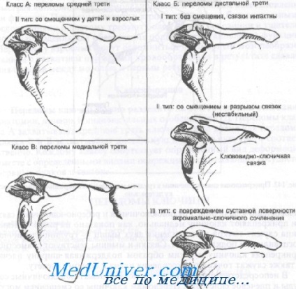 Fractura de clavicula