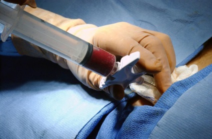 Transplantul măduvei osoase - eficacitatea metodei