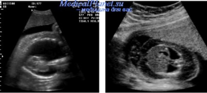 Excesul pleural