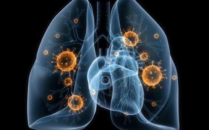 Ultima etapă a tuberculozei pulmonare