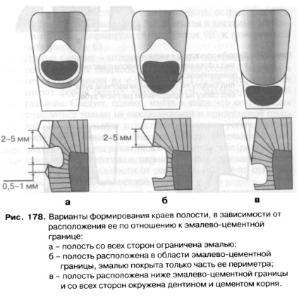 Disecția cavităților clasei v prin metoda este un bun portal dentar, bun