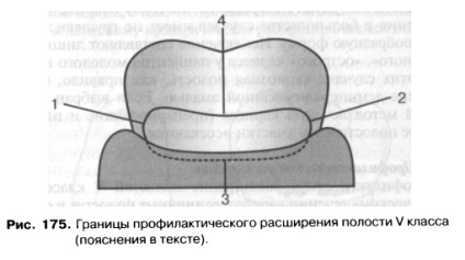 Disecția cavităților clasei v prin metoda este un bun portal dentar, bun