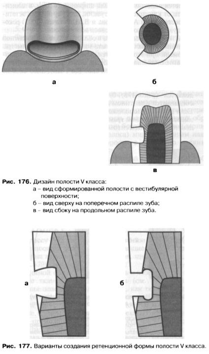 Disecția cavităților clasei v prin metoda este un bun portal dentar, bun