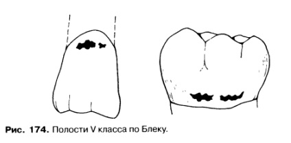 Disecția cavităților clasei v prin metoda este un bun portal dentar, bun