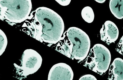 Epilepsziás rohamot -, hogyan lehet felismerni és segít, egészségügy és az orvostudomány