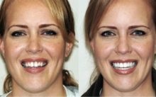 Curățarea dinților profesioniști - cât de mult este, fotografiile înainte și după, recenzii