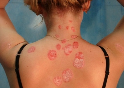 Psoriazis - Hanty-Mansiysk Clinical Skin and Dispersary Venere